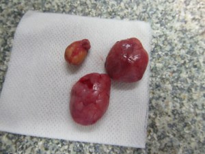 De verwijderde gezwellen